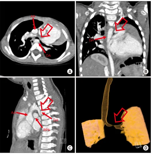 Fig. 1. Preoperative computed to- to-mography revealed left main  bron-chus compression between the  en-larged RPA and descending thoracic  aorta