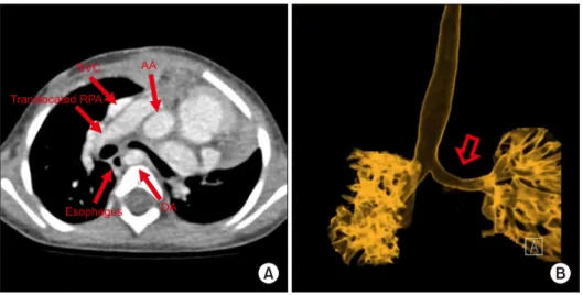 Fig. 3. Postoperative computed to- to-mography revealed left main  bron-chus improvement at 2 months  postoperatively