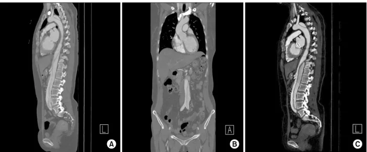 Fig. 1. (A) Initial CT shows type B dissection. (B) The right common iliac artery branched from the true lumen of the dissected abdominal  aorta