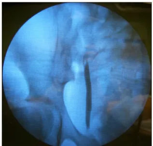 Fig. 4. After complete stone removal using cystolitholapaxy, retrograde pyelography was performed to evaluate other cause of ureteral  obstruction, showing absence of a filling defect.