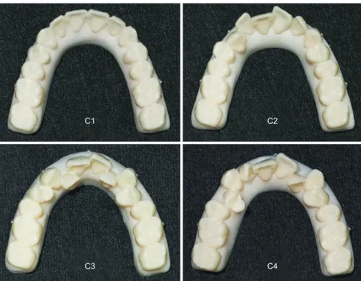Figure 1. Dental arch models according to the severity of tooth irregularity expressed as arch length discrepancy (ALD)