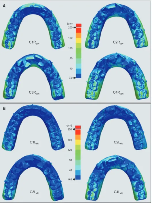 Figure 3. A color presentation  of the deviations between  surfaces from the iTero®  scan-ner