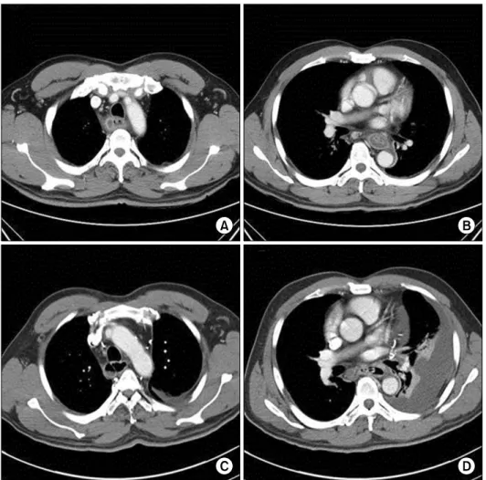 Fig. 1. (A) Chest CT showed a  1.5-×1-cm submucosal abscess of  the esophagus in the upper thoracic  esophagus and (B) diffuse  esoph-ageal wall thickening