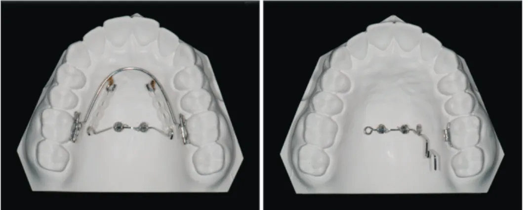 Figure 1. Midpalatal minisc- minisc-rew assisted maxillary molar  distalizer. Right, lingual  arch-type appliance; Left,  pendu-lum type appliance
