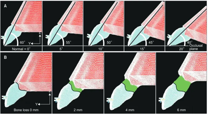 Figure 2. Models of incisors with different inclinations and different amounts of alveolar bone loss
