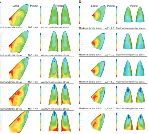 Figure 6. Incisor root stress  distribution patterns under  conditions with M t /F near  M t /F cont  (red area, maximum  tensile stress; blue area,  maximum compressive stress)