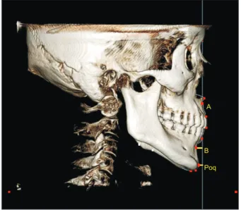 Figure 4. The true horizontal plane, midsagittal plane,  and nasion true vertical plane were constructed.