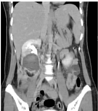 Fig.  3.  Computed  tomography  shows  14x10cm 2   sized  urinoma  with  leakage  of  contrast  media  from  the  renal  pelvis  3weeks  after  trauma,  .