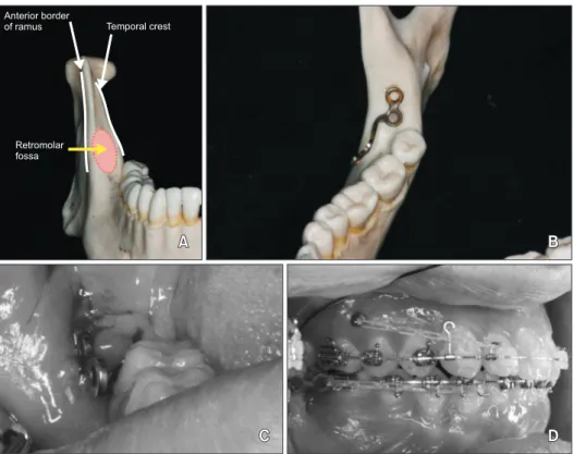 Figure 1. The placement site  of the ramal plate showing  the retromolar fossa. A, The  placement site of the ramal  plate; B, the ramal plate after  adjustment to fit into the  retromolar fossa; C, the ramal  plate emerging through the  attached gingiva; 