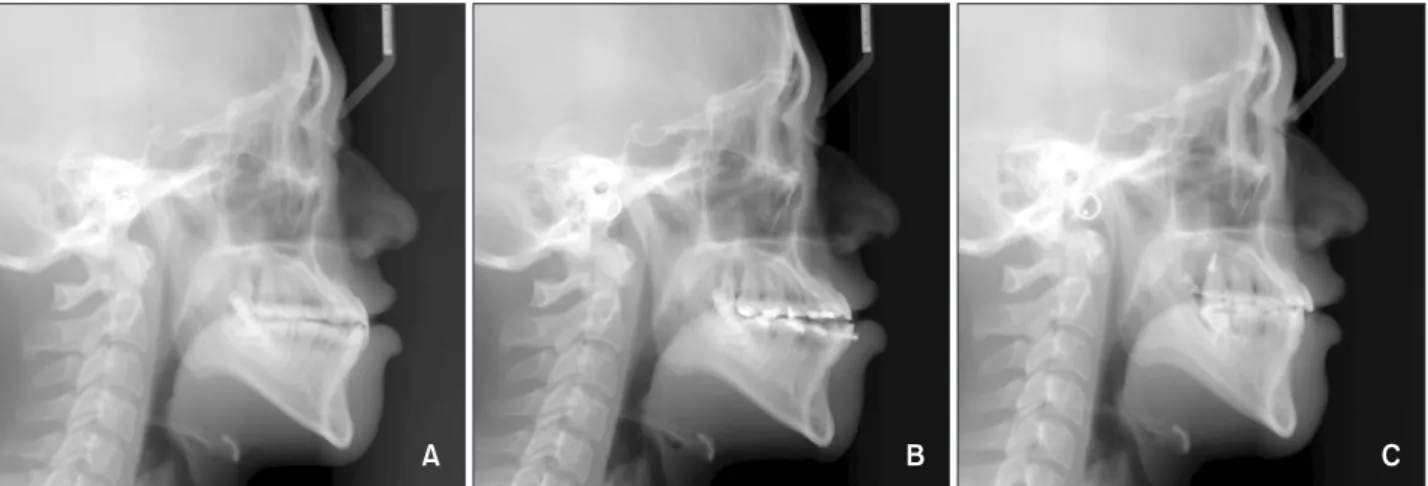 Figure 2. Cephalometric radiographs are shown. A, Pretreatment; B, after leveling and alignment; and C, post-treatment.