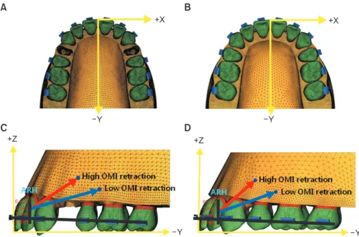Figure 1. Three-dimensional finite element models. A, Occlusal view of the model with extraction of the first premolar  (Model 1, M1)