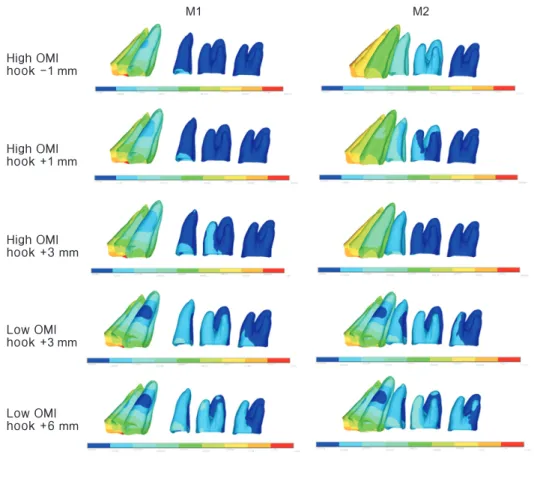 Figure 2. Von Mises stress  distribution (g/mm 2 ). M1,  Model 1; M2, Model 2; OMI,  orthodontic mini-implants.