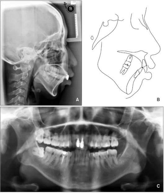 Figure 3. Pretreatment cepha- cepha-logram (A), cephalometric  tracing (B), and panoramic  radiograph (C)