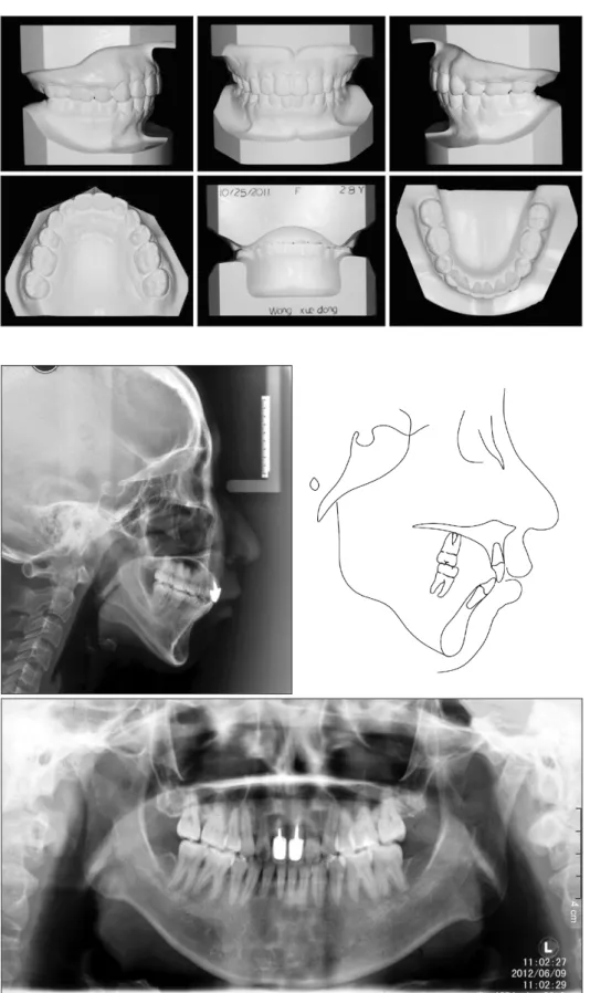 Figure 9. Post-treatment  dental casts. The dentition  is well aligned, the scissor  bite and deep overbite are  corrected, and ideal  intercus-pation with solid lingual  occlusion is achieved.