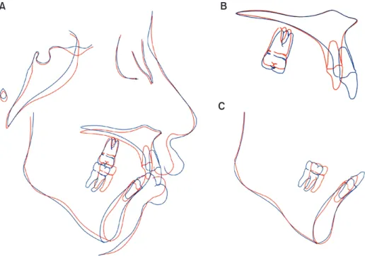 Figure 11. Pre- and post-treatment cephalometric superimpositions showing marked differences before (blue) and after  (red)  treat ment