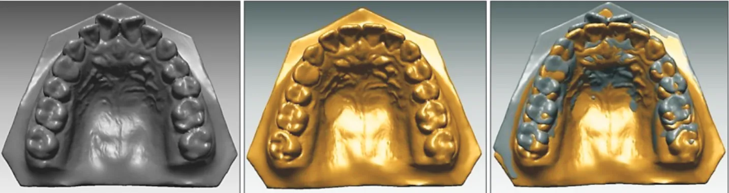 Figure 1. Superimposition of three-dimensional pretreatment and post-treatment virtual maxillary models.