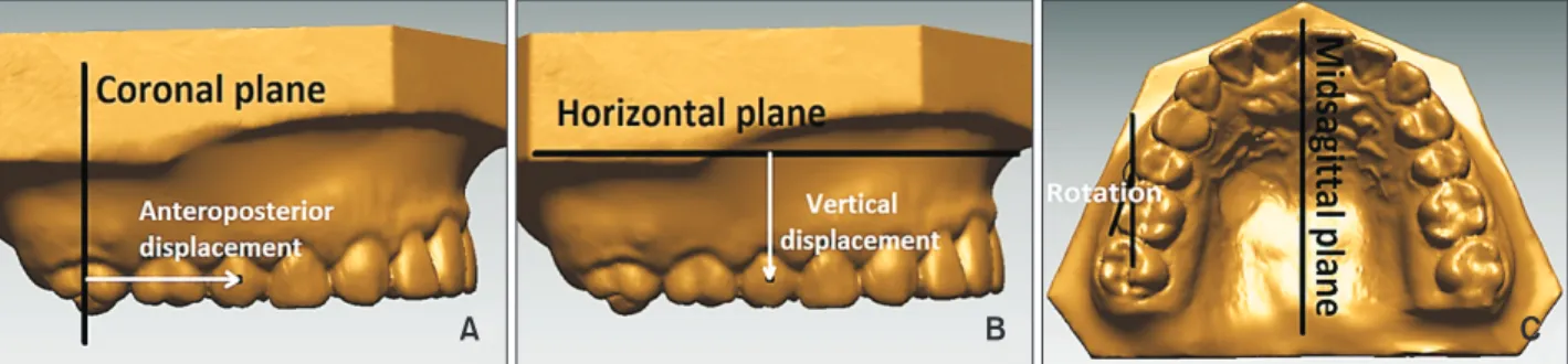 Figure 5. Definitions of linear and angular variables. A, Anteroposterior displacement (mm): distance between the facial  axis (FA) point and the coronal plane