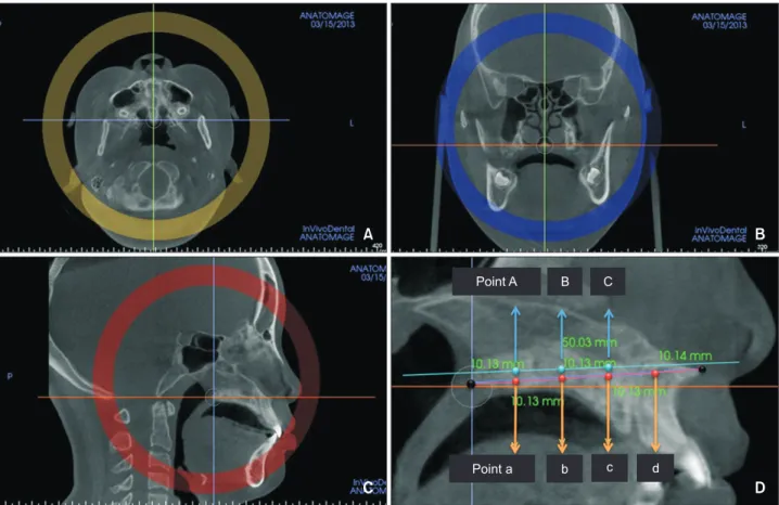 Figure 1. Head reorientation and setting of the axial cross-sectional planar view. A, An axial plane view; B, a coronal  plane view; C, a sagittal plane view; and D, a midsagittal plane view.