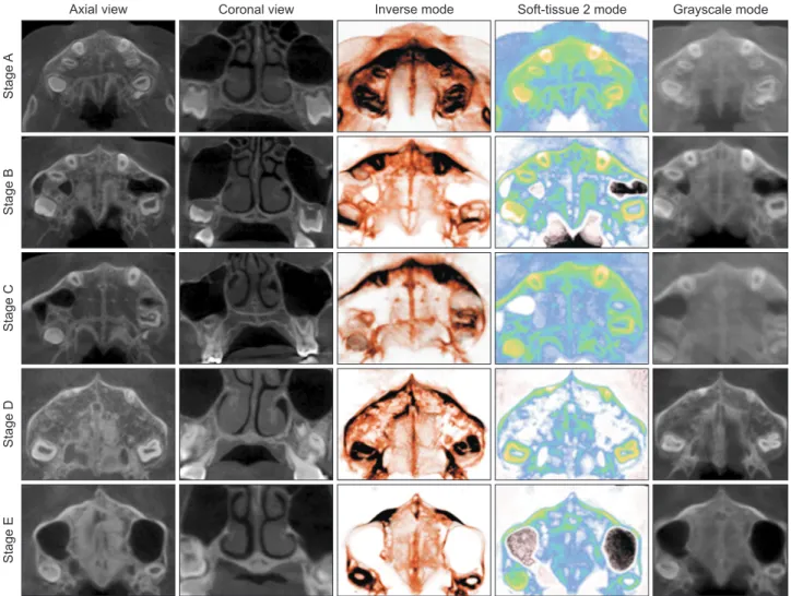 Figure 2. Cone-beam computed tomography images of the midpalatal suture and volume-rendered images according to  maturation stage.