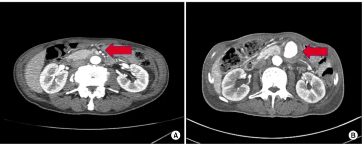 Fig. 1. Abdominal computed tomography. (A) Before cardiac surgery. No signs of aneurysm (arrow)