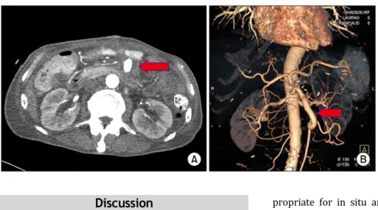 Fig. 3. Postoperative computed to- to-mography (CT). (A) The aneurysm  had decreased in size compared to  the previous CT scan (arrow)