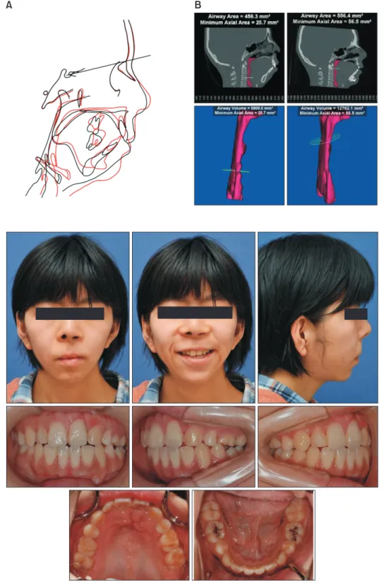 Figure 14. Assessment of the  airway space after treatment. 