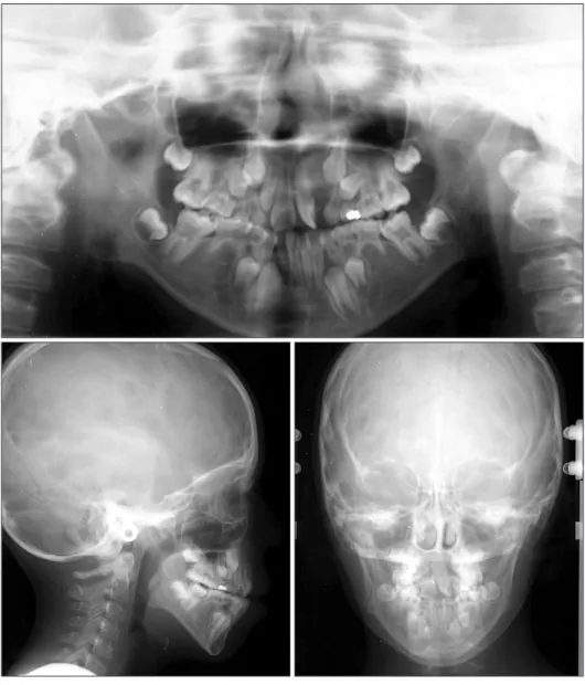 Figure 3. Initial panoramic and  cephalometric radiographs.