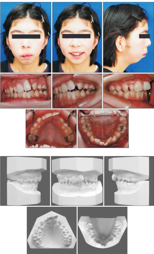 Figure 6. Dental casts fabri- fabri-cated before the second phase  of treatment.