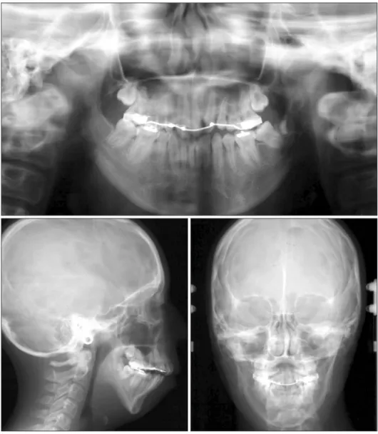 Figure 7. Panoramic and  cephalometric radiographs  obtained before the second  phase of treatment.