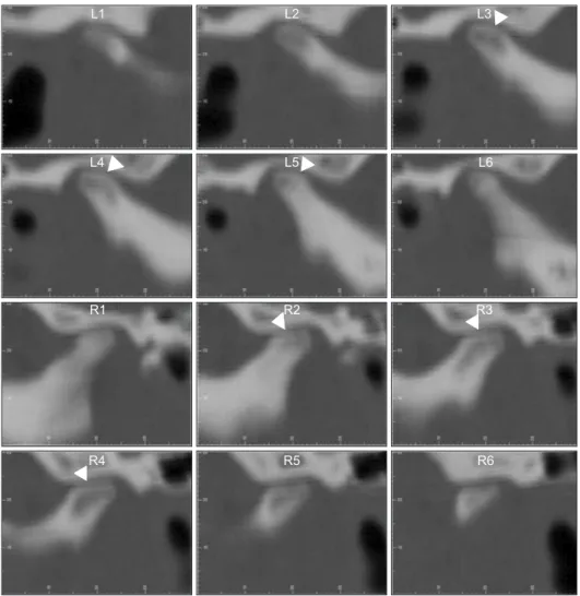 Figure 8. Computed tomo- tomo-graphy images of the bilateral  condyles for our patient with  bilateral condylar deformities  after growth completion