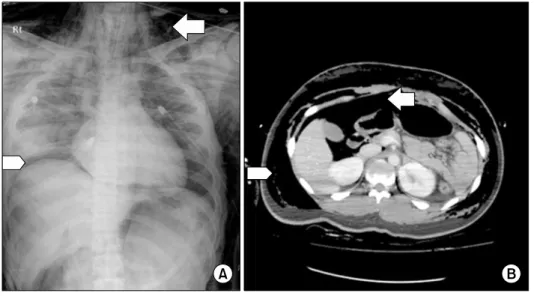Fig. 1. (A) Taken immediately after  intubation, a chest X-ray shows a  suddenly developed massive  pneu-moperitoneum (arrow) and  sub-cutaneous emphysema (arrowhead)  without any evidence of  pneumo-thorax