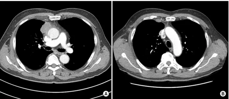 Fig. 1. (A) Contrast-enhanced chest computed tomography scan, showing a 2.6-cm mass in the right anterior mediastinum