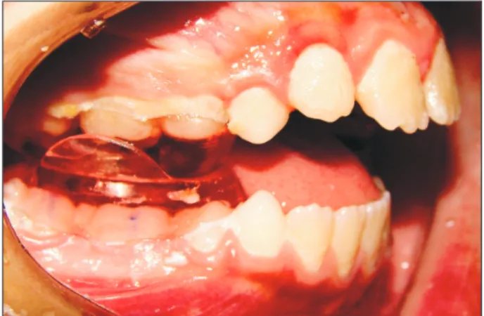 Figure  1. Magnetic bite-blocks in the mouth. Buccal  wings were added to the lower biting-blocks to prevent  the development of posterior crossbite.