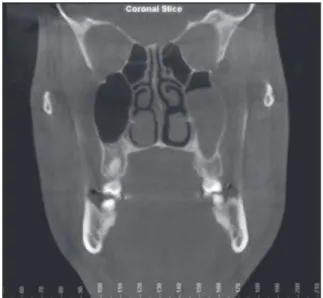 Figure 6.  Coronal  cone-beam  computed  tomography  image showing nasal septum deviation, right turbinate  hypertrophy, and left maxillary sinus congestion.