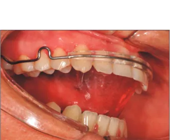 Figure 15. Tongue elevator for retention.