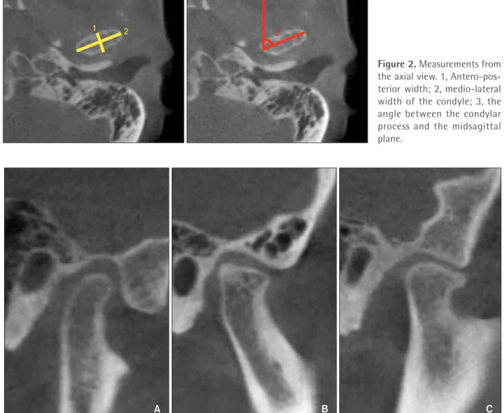 Figure 3. Different shapes of condyles. A, Normal. B, Flattened. C, Osteophyte.