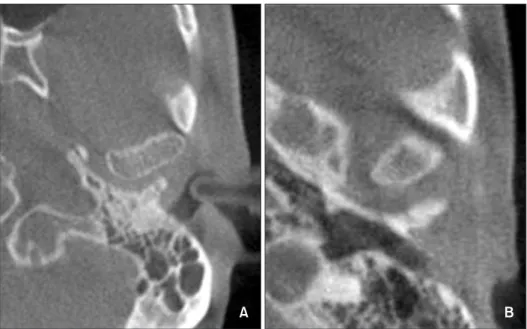 Figure 4. Condylar shape di- di-fference within the normal  group. A, Oval. B, Round.