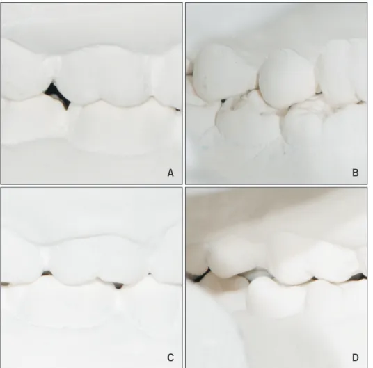 Figure 1. Classification of  class I and II finishings. A,  Class I finishing viewed from  the buccal aspect