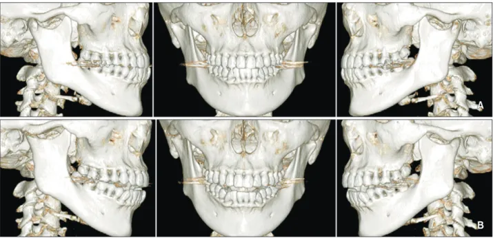 Figure 2. Computed tomography images of the left condyle. The white arrow illustrates osteophytes.