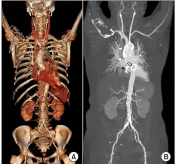 Fig. 2. (A) The interatrial groove  was exposed with minimal intra-  pericardial dissection via a right  mini-thoracotomy (black arrow, right atrium; white arrow, left atrial  wall; black arrowhead, previous  su-ture for left atrial closure), and (B)  the 