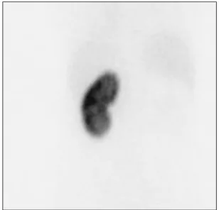 Fig. 3. (A) Gross finding, (B, C) micro- micro-scopic findings (H&amp;E stain; B, ×2; C, 