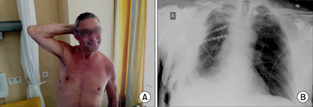Fig. 3. (A, B) The patient has good  pulmonary function without pain or  thoracic deformity.