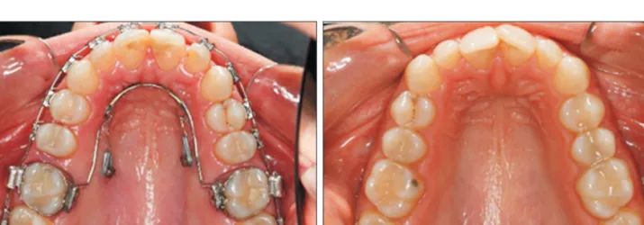 Figure 1. Mini-implant-aided trans palatal arch molar distalizing appliances include a horseshoe shaped palatal bar  inserted in the palatal sheath, and two miniscrews between the 1st molar and 2nd premolar