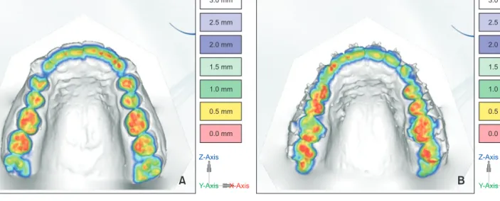 Figure 3. Evaluation methods of vertical teeth movement by three-dimensional digital model