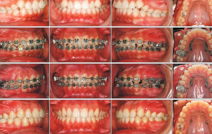 Table 2. Digital model measurements before and after maxillary molar distalization