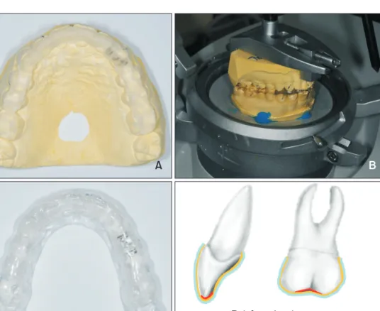 Figure 1. The fabrication  pro cess of multi-layer  vacu-um-formed retainers (VFRs). 