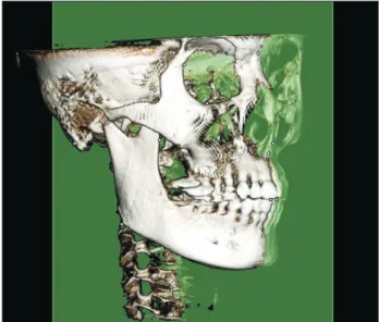 Figure 1. Landmarks used in three-dimensional cone- cone-beam computed tomography analysis.