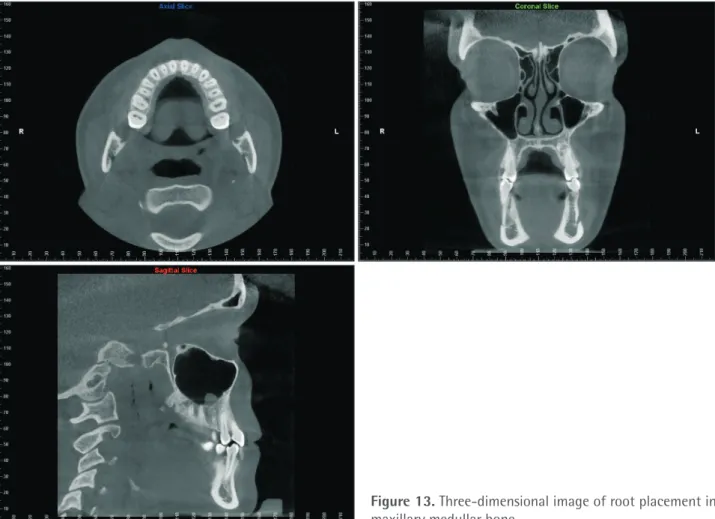 Figure 13. Three-dimensional image of root placement in  maxillary medullar bone.