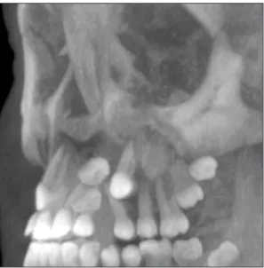 Figure 4. Three-dimensional reconstruction of the maxi- maxi-lla, with transposition of the left canine and first  pre-molar.
