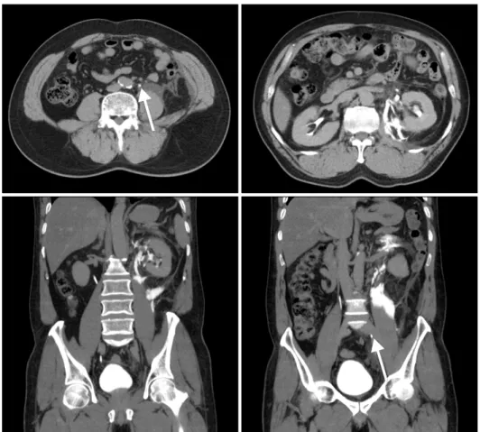 Fig. 1. An abdominal computed tomo- tomo-graphic scan showed about 5 mm sized  upper ureter stone (arrows) with  hydro-nephroureterosis and perinephric fluid  collection.